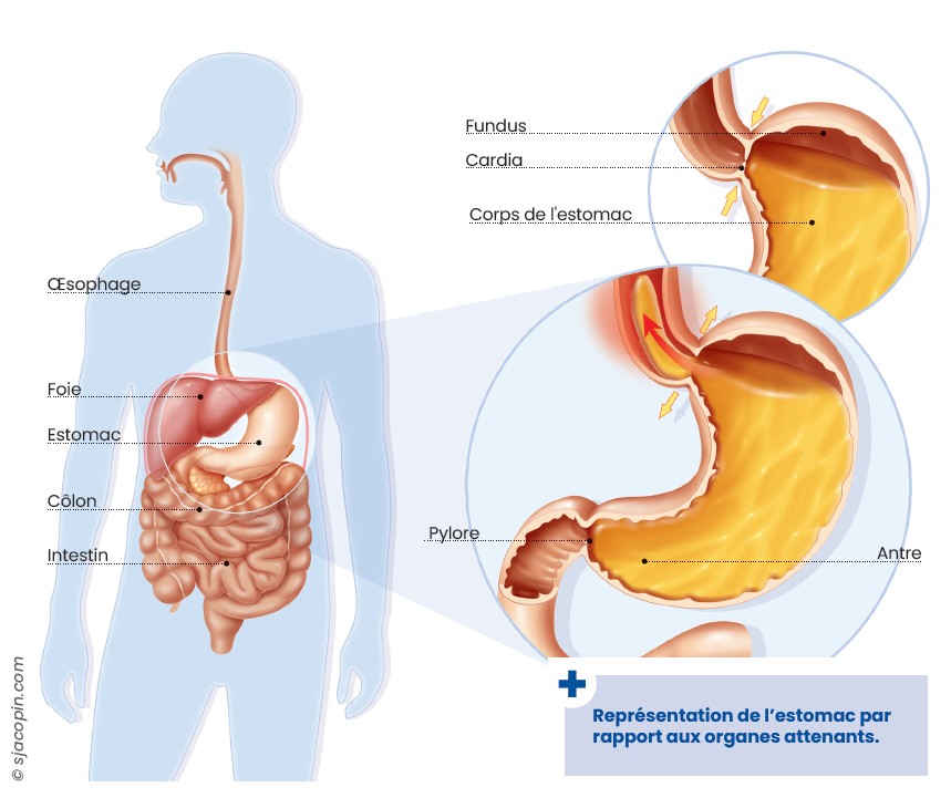 Schéma de l'estomac montrant les trois zones où un cancer peut se développer : cardia, corps et antre/pylore