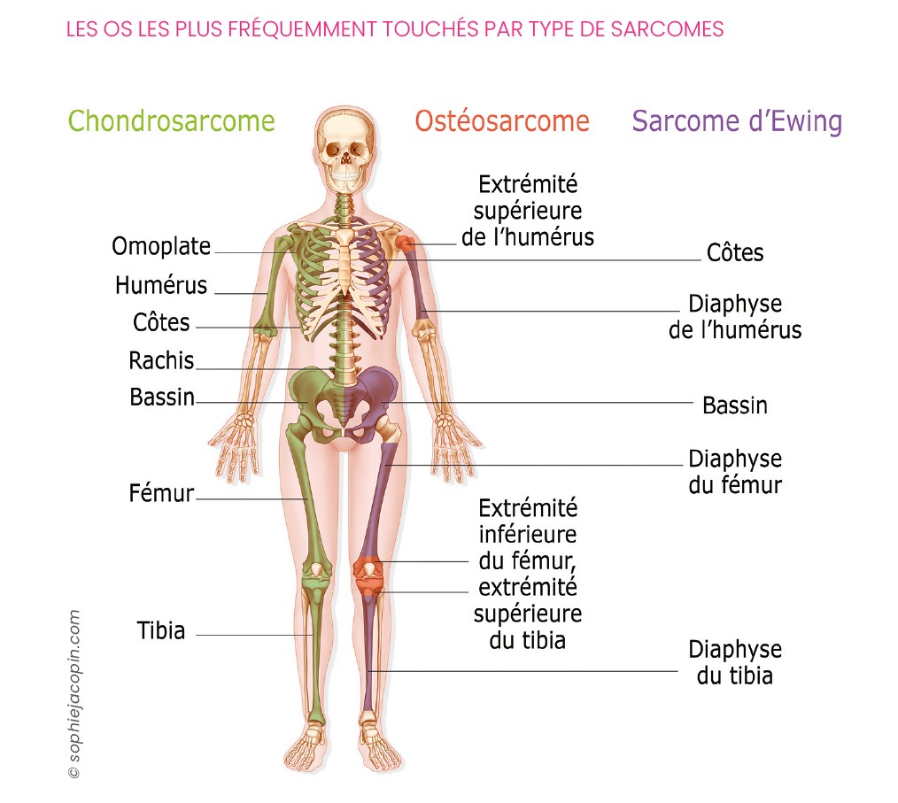 Os Sarcomes